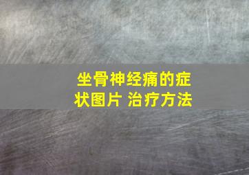 坐骨神经痛的症状图片 治疗方法